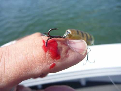 Show us your fishing injuries! (GRAPHIC CONTENT) - General Fishing