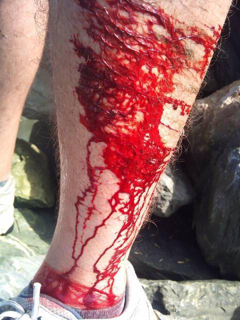 Rock fishing injury.jpg